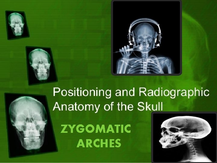 ZYGOMATIC ARCHES 
