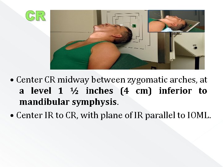 CR • Center CR midway between zygomatic arches, at a level 1 ½ inches