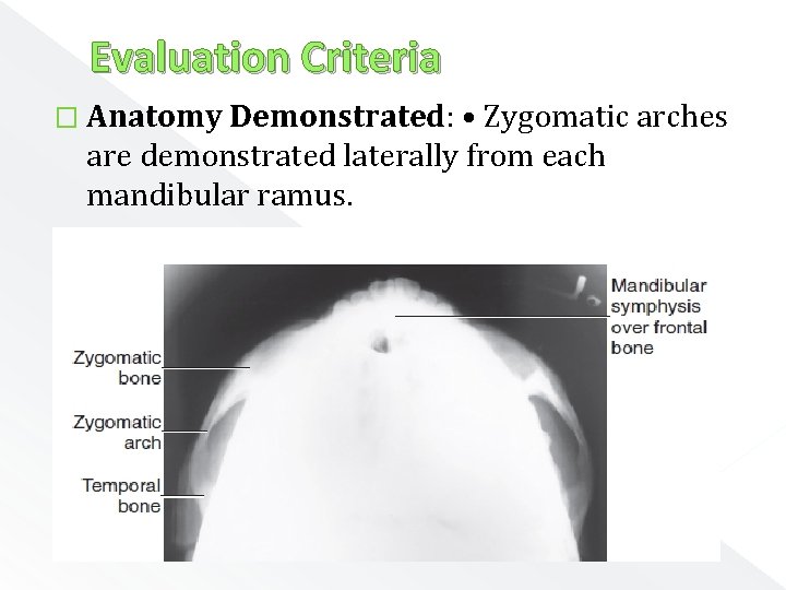 Evaluation Criteria � Anatomy Demonstrated: • Zygomatic arches are demonstrated laterally from each mandibular