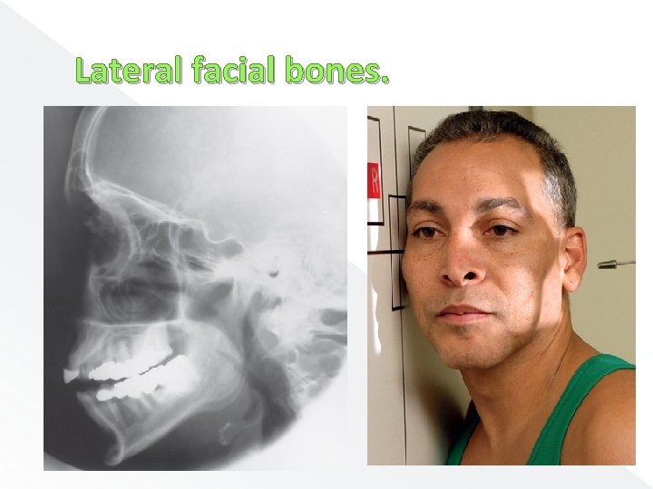 Lateral facial bones. 