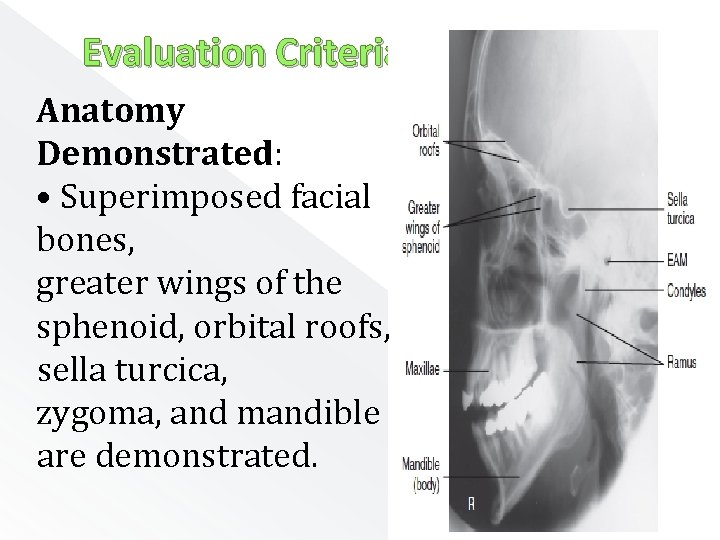 Evaluation Criteria Anatomy Demonstrated: • Superimposed facial bones, greater wings of the sphenoid, orbital