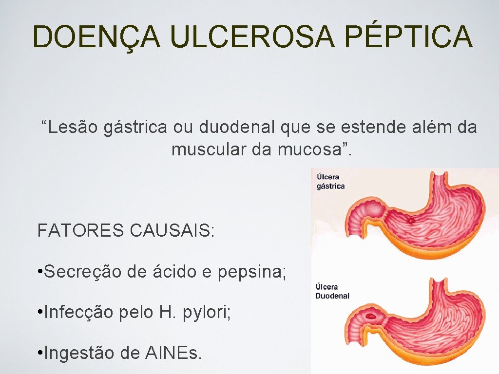 DOENÇA ULCEROSA PÉPTICA “Lesão gástrica ou duodenal que se estende além da muscular da