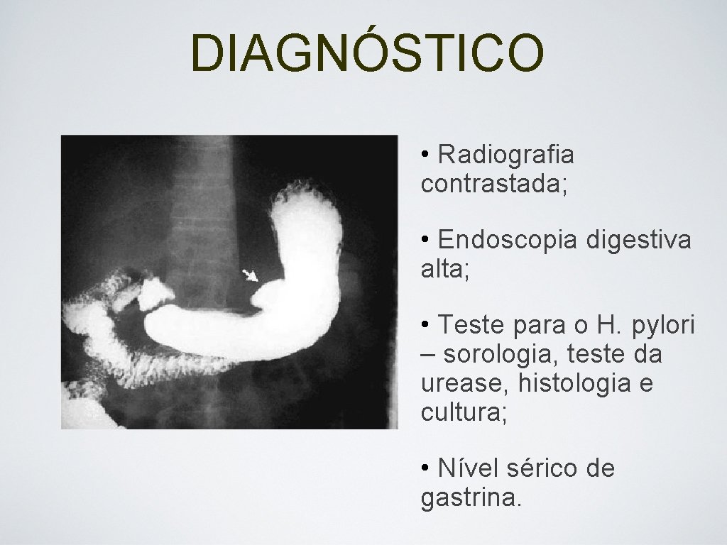 DIAGNÓSTICO • Radiografia contrastada; • Endoscopia digestiva alta; • Teste para o H. pylori