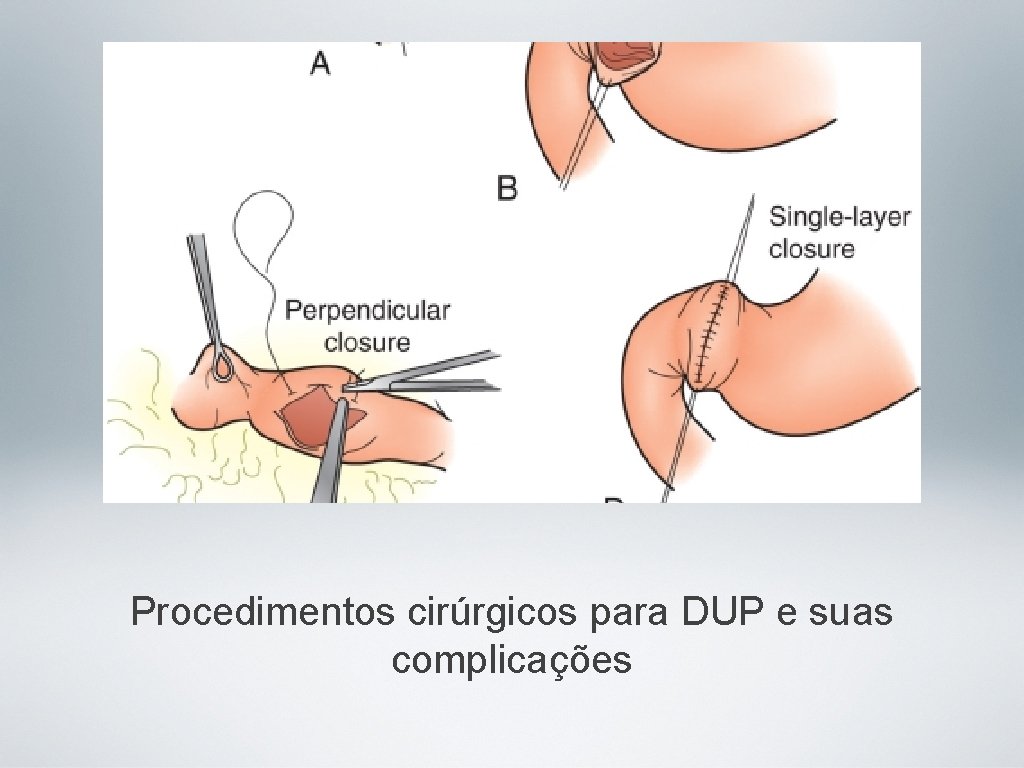 Procedimentos cirúrgicos para DUP e suas complicações 