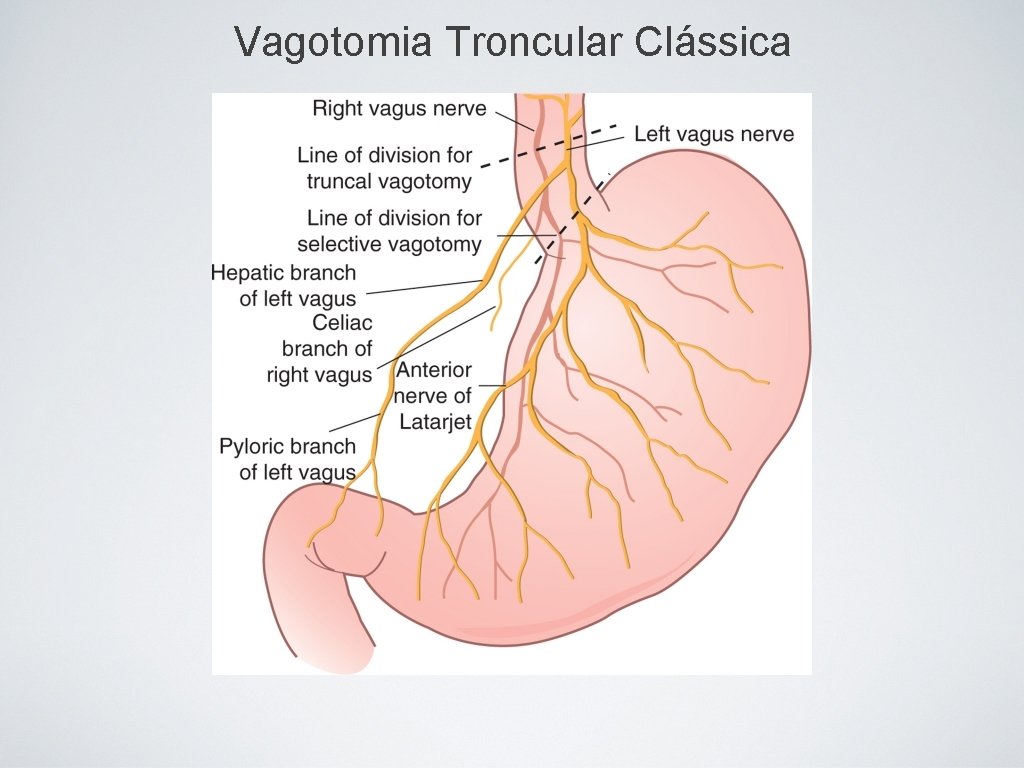 Vagotomia Troncular Clássica 