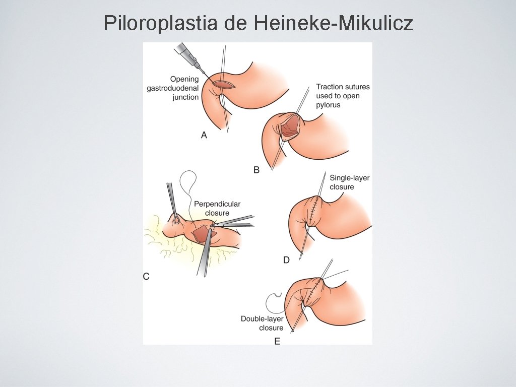 Piloroplastia de Heineke-Mikulicz 