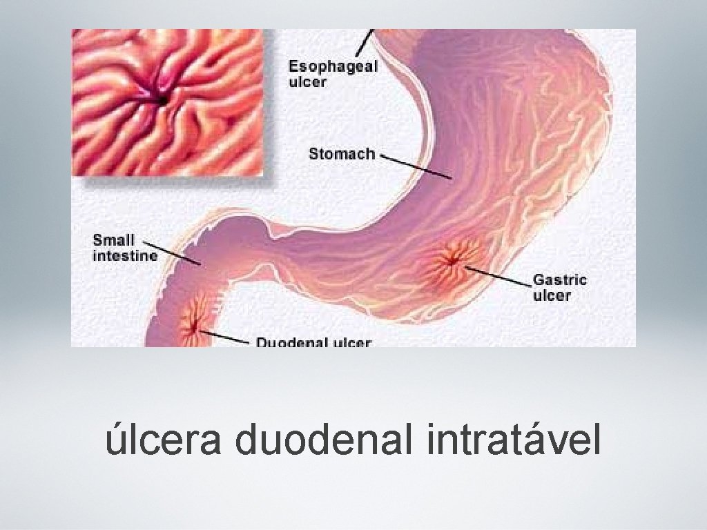 úlcera duodenal intratável 