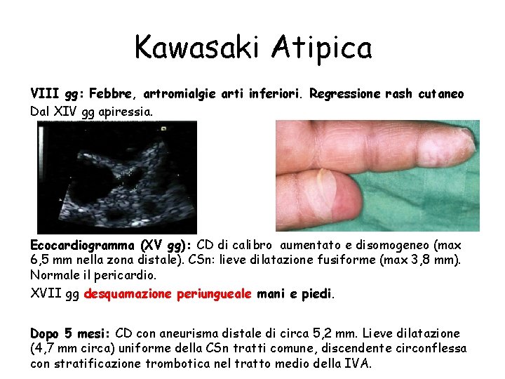 Kawasaki Atipica VIII gg: Febbre, artromialgie arti inferiori. Regressione rash cutaneo Dal XIV gg