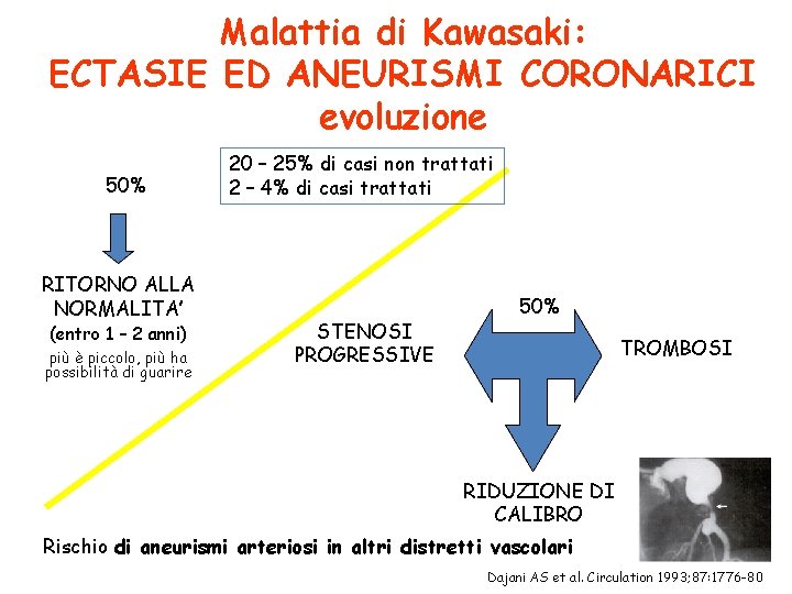 Malattia di Kawasaki: ECTASIE ED ANEURISMI CORONARICI evoluzione 50% RITORNO ALLA NORMALITA’ (entro 1