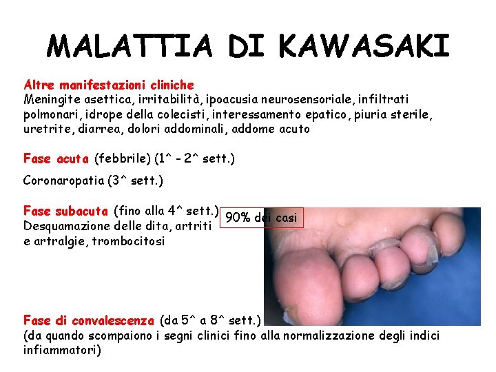 MALATTIA DI KAWASAKI Altre manifestazioni cliniche Meningite asettica, irritabilità, ipoacusia neurosensoriale, infiltrati polmonari, idrope