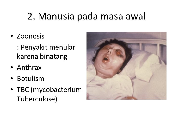 2. Manusia pada masa awal • Zoonosis : Penyakit menular karena binatang • Anthrax