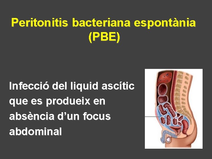 Peritonitis bacteriana espontània (PBE) Infecció del liquid ascític que es produeix en absència d’un