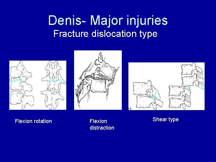 Denis- Major injuries Fracture dislocation type Flexion rotation Flexion distraction Shear type 