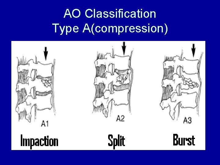 AO Classification Type A(compression) 