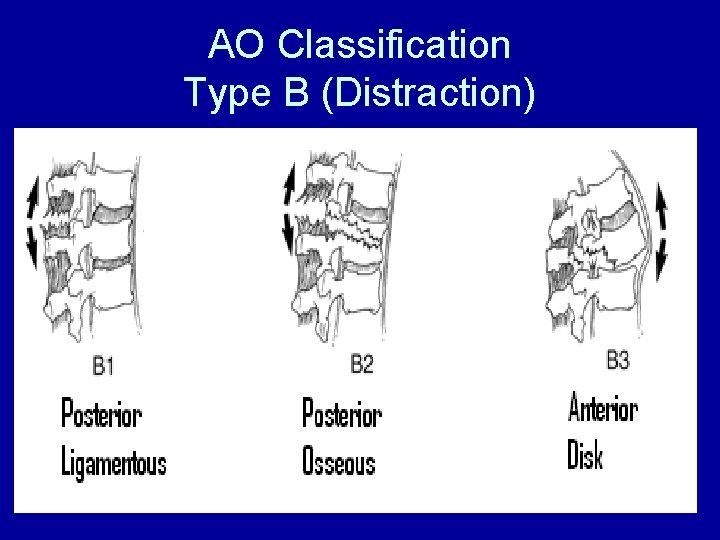 AO Classification Type B (Distraction) 