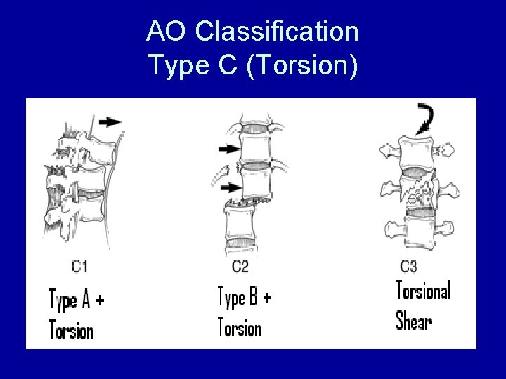 AO Classification Type C (Torsion) 