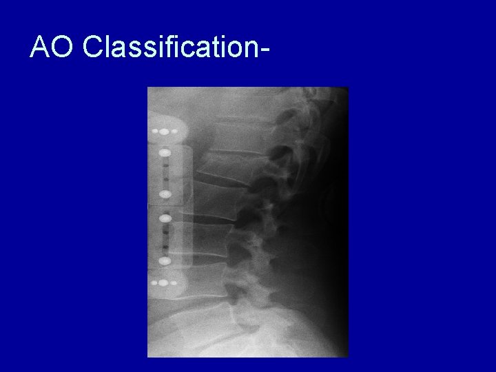 AO Classification- 