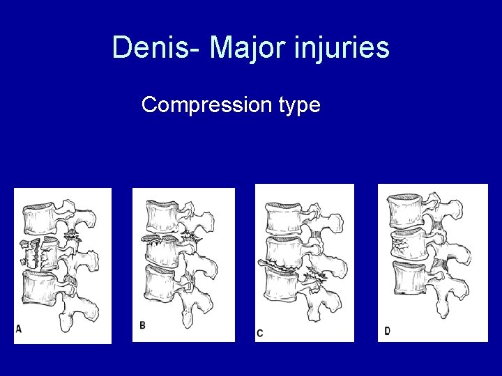 Denis- Major injuries Compression type 