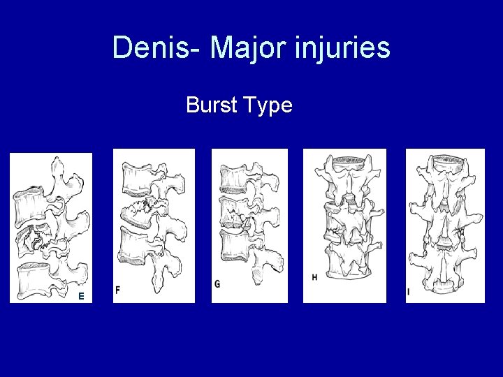 Denis- Major injuries Burst Type E 