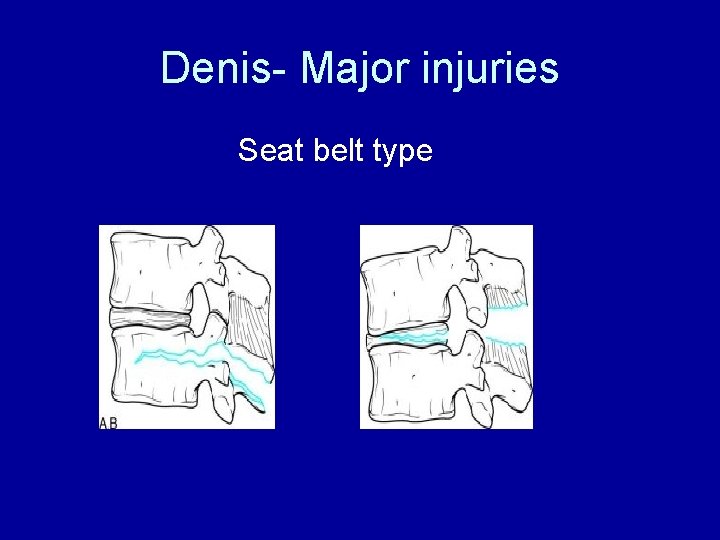Denis- Major injuries Seat belt type 