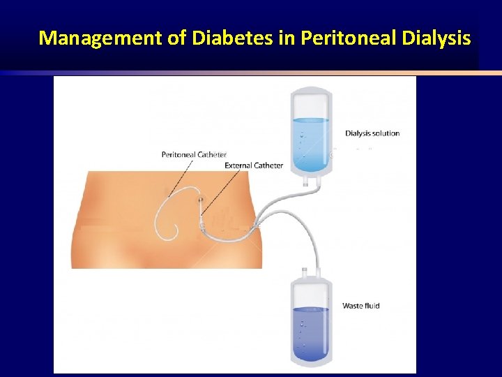 Management of Diabetes in Peritoneal Dialysis 