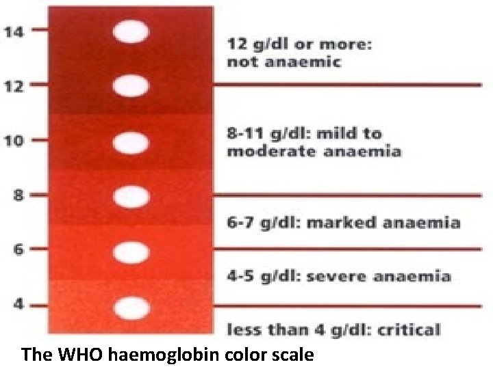 The WHO haemoglobin color scale 