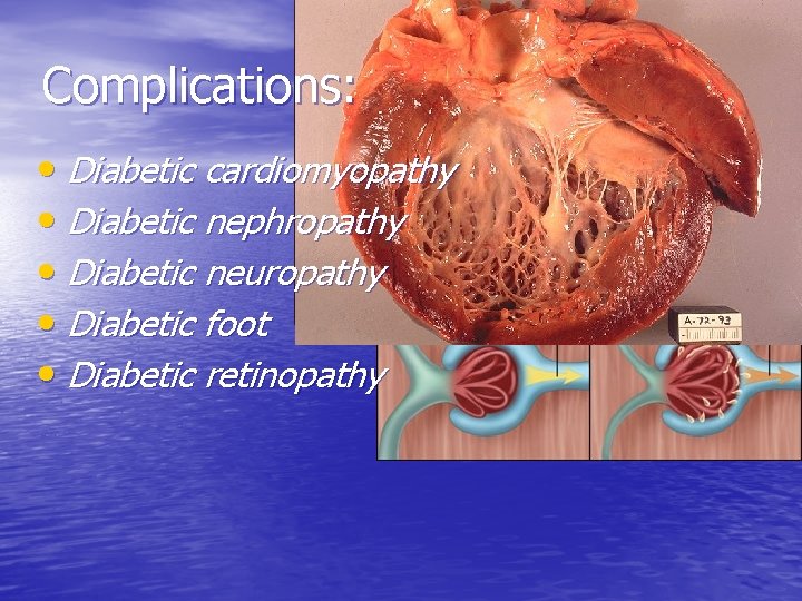 Complications: • Diabetic cardiomyopathy • Diabetic nephropathy • Diabetic neuropathy • Diabetic foot •