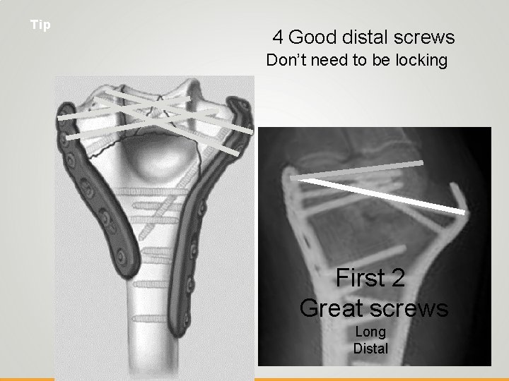 Tip 4 Good distal screws Don’t need to be locking First 2 Great screws