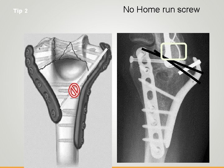 Tip 2 No Home run screw 