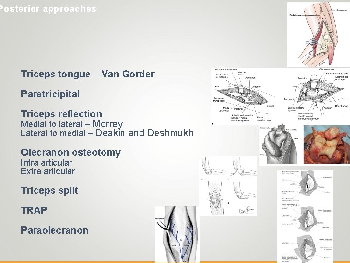 Posterior approaches Triceps tongue – Van Gorder Paratricipital Triceps reflection Medial to lateral –