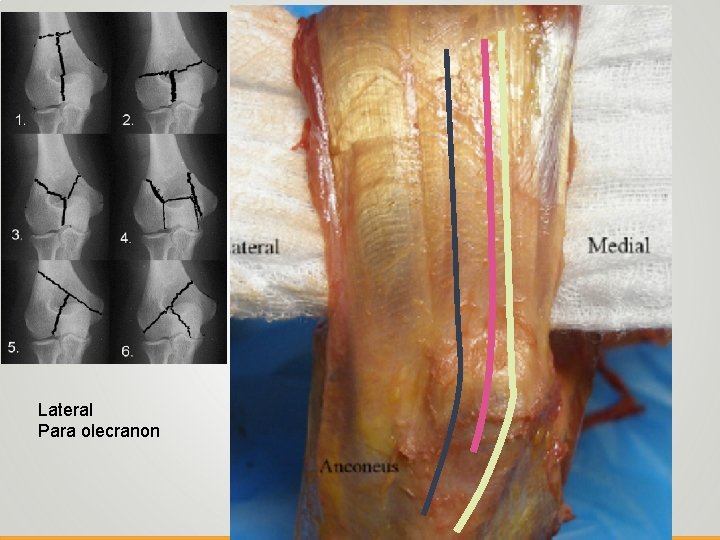 Lateral Para olecranon 