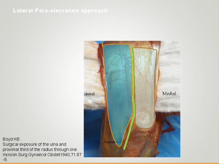 Lateral Para-olecranon approach Boyd HB. Surgical exposure of the ulna and proximal third of