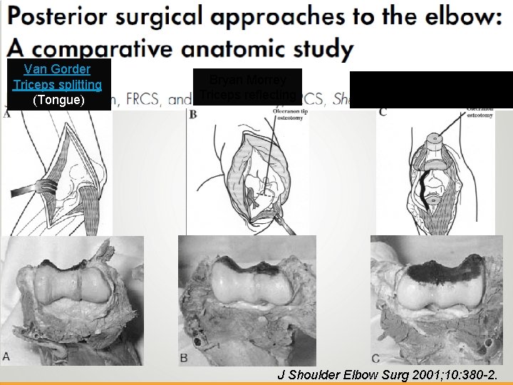 P o s t e Van Gorder r Triceps splitting i (Tongue) o r