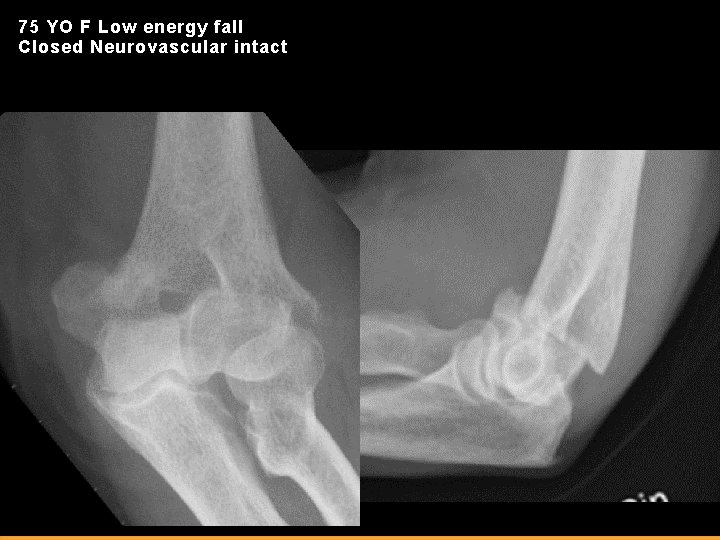 75 YO F Low energy fall Closed Neurovascular intact 