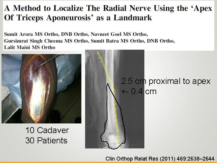 2. 5 cm proximal to apex +- 0. 4 cm 10 Cadaver 30 Patients