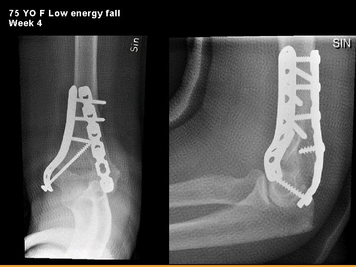 75 YO F Low energy fall Week 4 