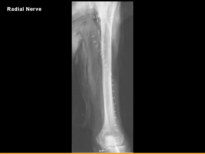 Radial Nerve 