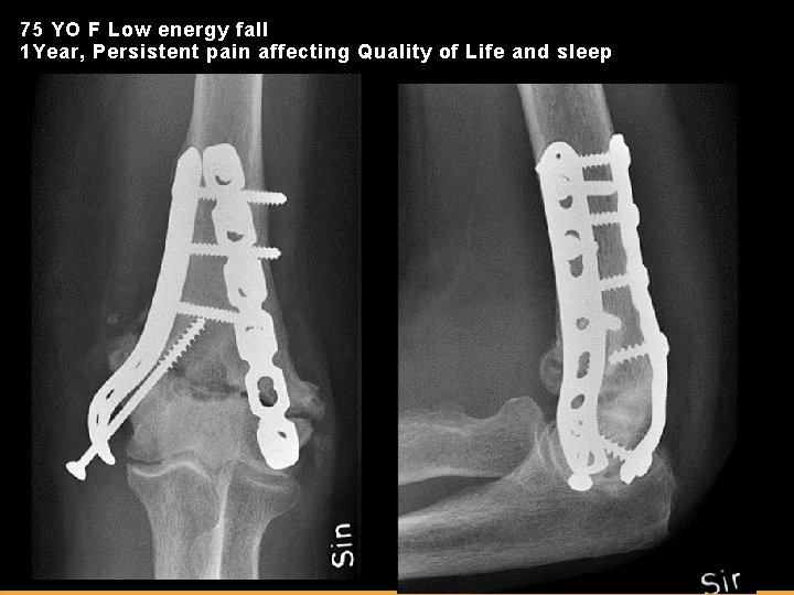 75 YO F Low energy fall 1 Year, Persistent pain affecting Quality of Life
