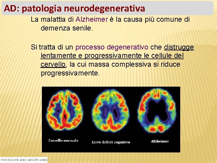 AD: patologia neurodegenerativa La malattia di Alzheimer è la causa più comune di demenza