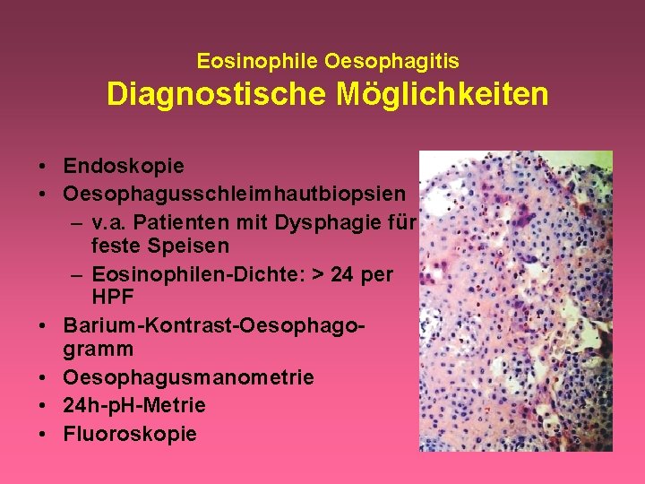 Eosinophile Oesophagitis Diagnostische Möglichkeiten • Endoskopie • Oesophagusschleimhautbiopsien – v. a. Patienten mit Dysphagie