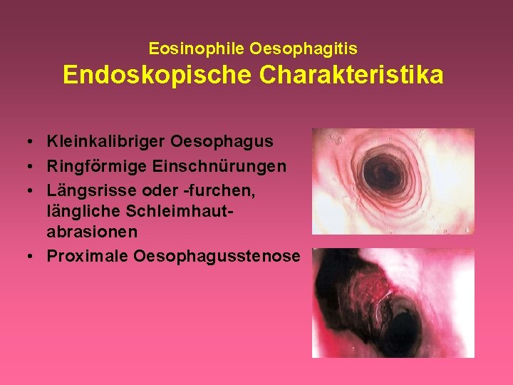 Eosinophile Oesophagitis Endoskopische Charakteristika • Kleinkalibriger Oesophagus • Ringförmige Einschnürungen • Längsrisse oder -furchen,