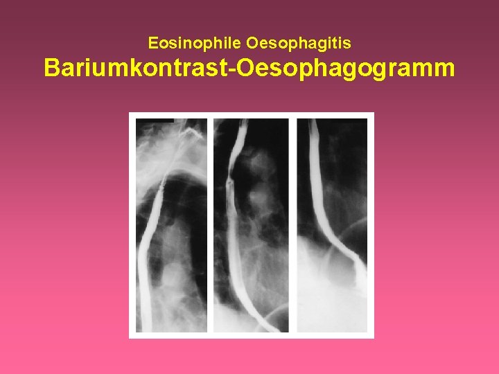 Eosinophile Oesophagitis Bariumkontrast-Oesophagogramm 