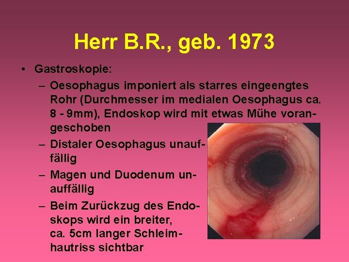 Herr B. R. , geb. 1973 • Gastroskopie: – Oesophagus imponiert als starres eingeengtes