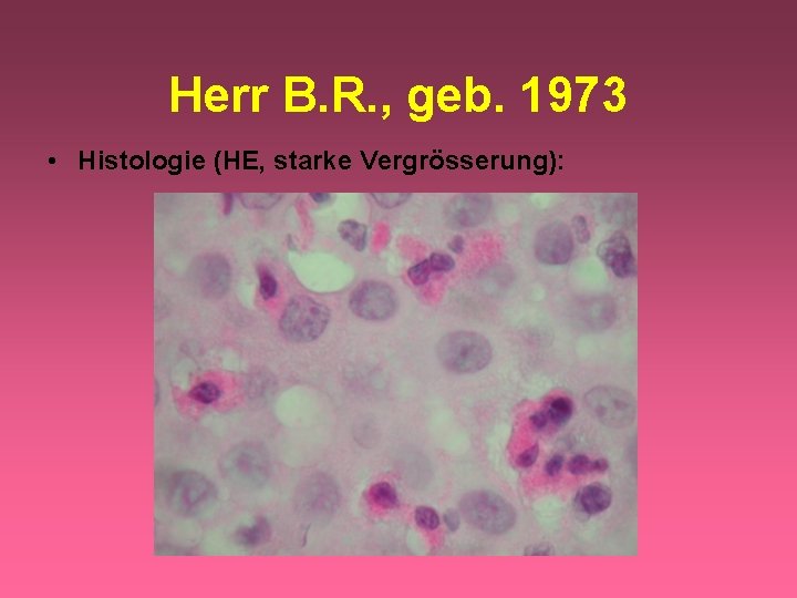 Herr B. R. , geb. 1973 • Histologie (HE, starke Vergrösserung): 