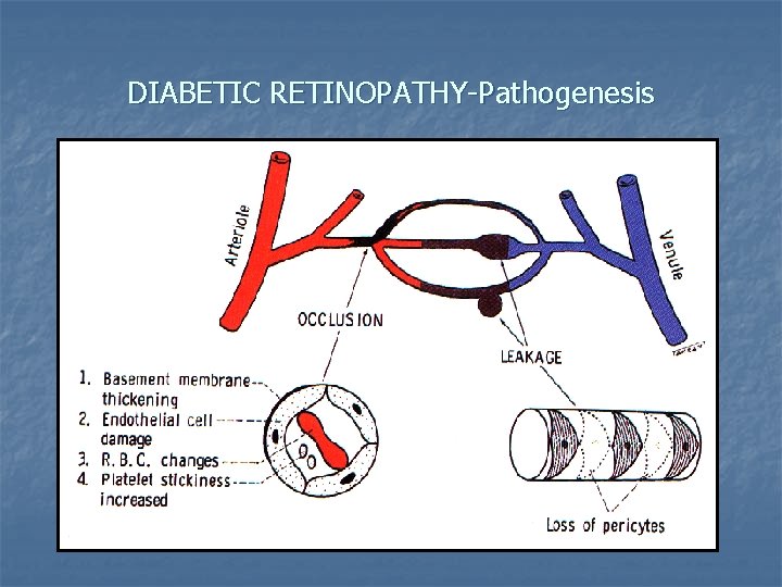 DIABETIC RETINOPATHY-Pathogenesis 
