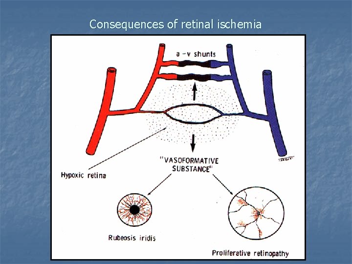 Consequences of retinal ischemia 