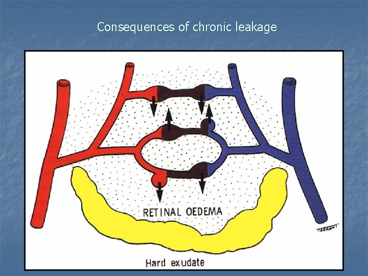 Consequences of chronic leakage 