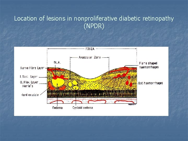 Location of lesions in nonproliferative diabetic retinopathy (NPDR) 