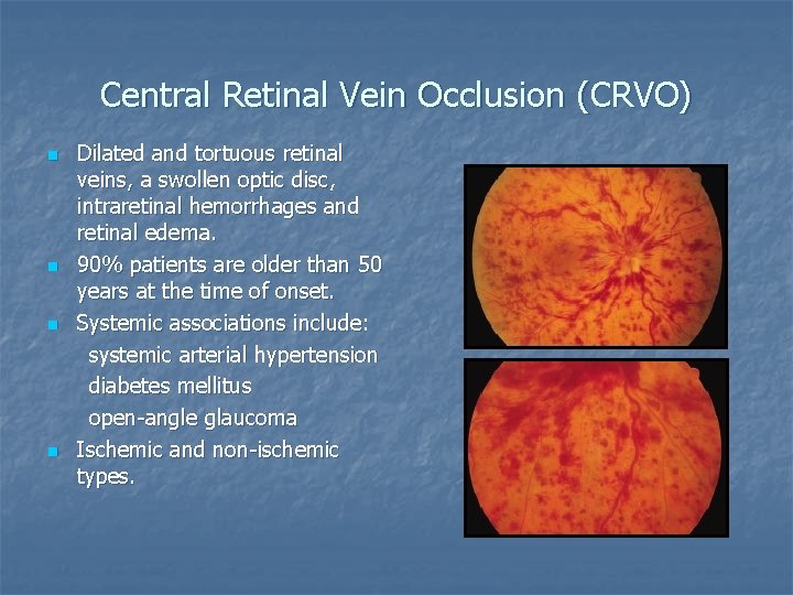 Central Retinal Vein Occlusion (CRVO) n n Dilated and tortuous retinal veins, a swollen