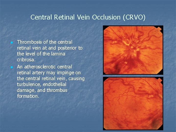 Central Retinal Vein Occlusion (CRVO) n n Thrombosis of the central retinal vein at